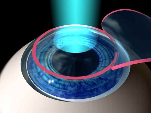 Ophthalmic Lasers Market Size, Share, Industry Analysis, Trends, Growth, Forecasts, 2032