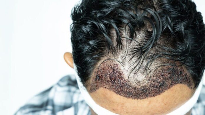 Hair transplant in Dubai