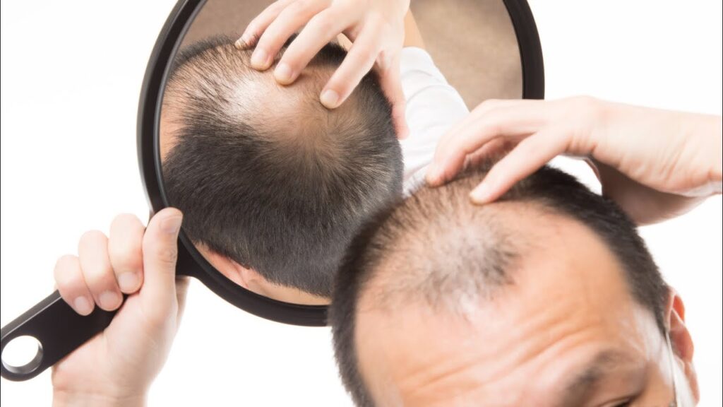 Hair transplant in Dubai