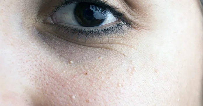 Milia Treatments in Dubai