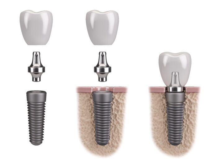 How to Find the Best Dental Implants Provider