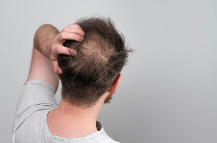 Is FUE Hair Transplant Better Than Hair Restoration?