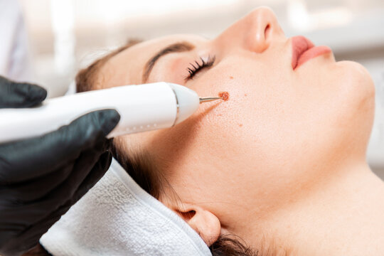 Laser wart removal in Dubai