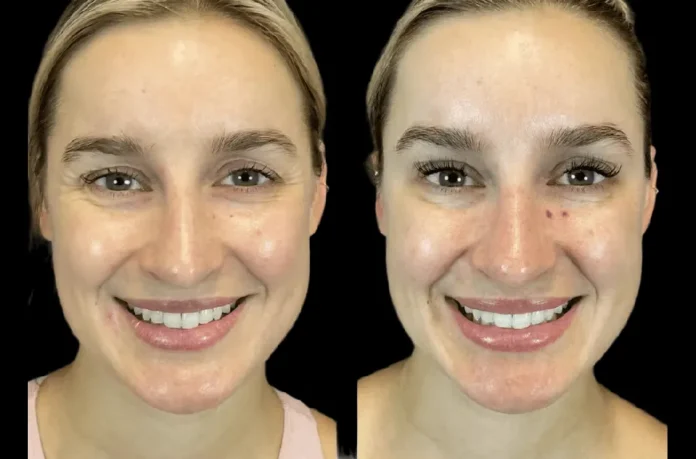 Botox in dubai