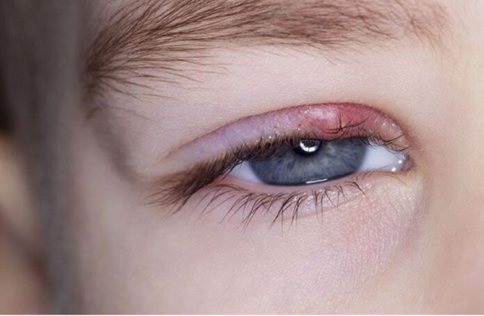 stye relief uk