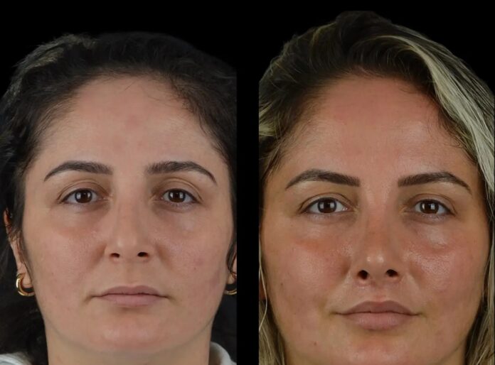 cheek fillers in dubai